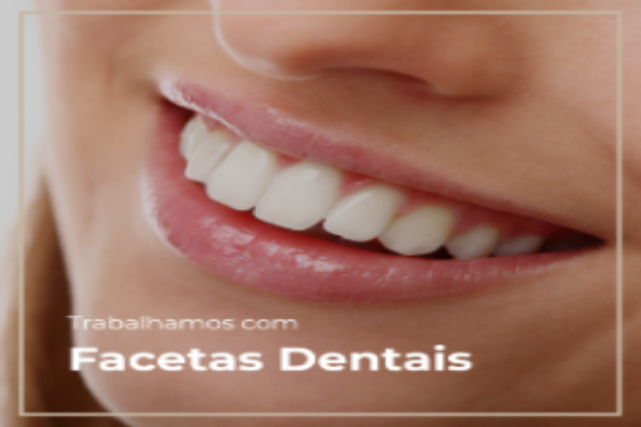 Facetas Dentais