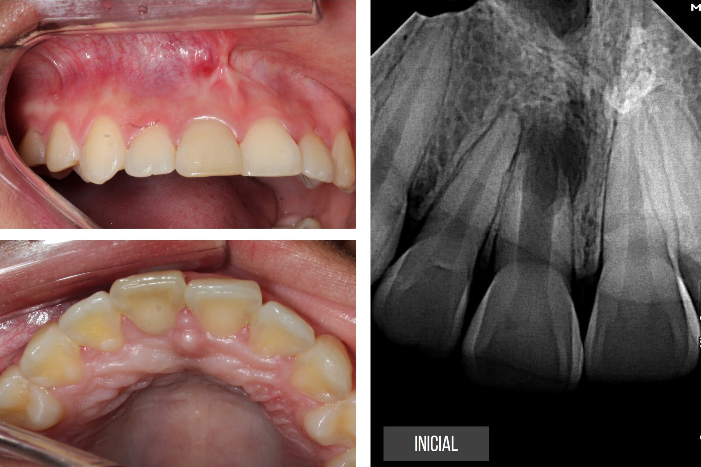 Revascularização Pulpar