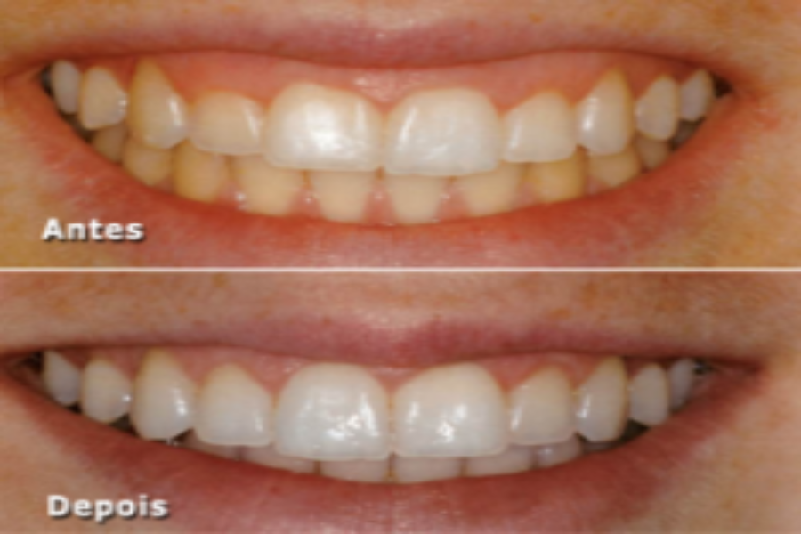 Correção de Sorriso Gengival