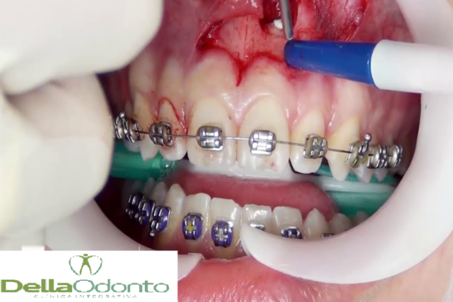 Cirurgia Endodôntica  Apicectomia