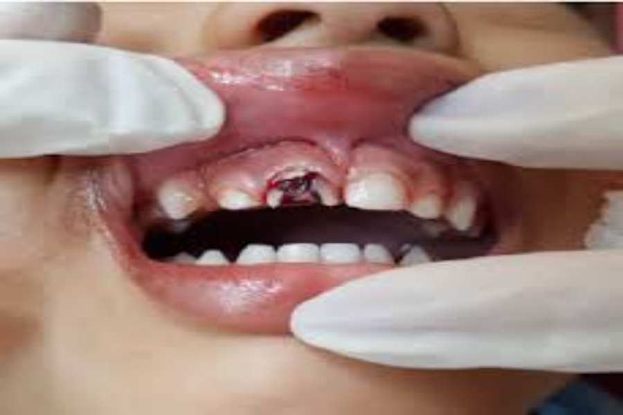 Tratamento de Trauma Dental