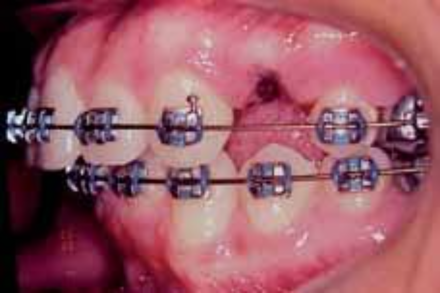 Extrações de Pré-Molares para Ortodontia