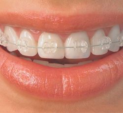 Aparelho Ortodôntico  Estético