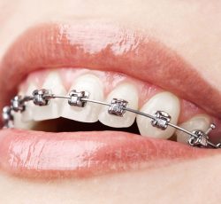 Aparelho Ortodôntico Fixo