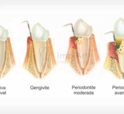 Periodontite