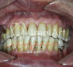 Doença Periodontal